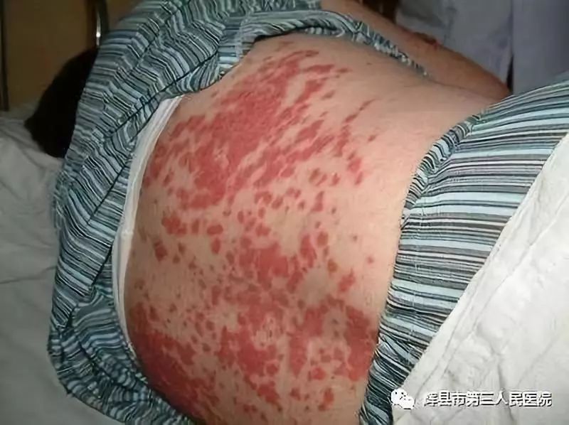 皮疹皮疹是本病的另一主要表现,85%以上的患者在病程中出现一过性皮疹