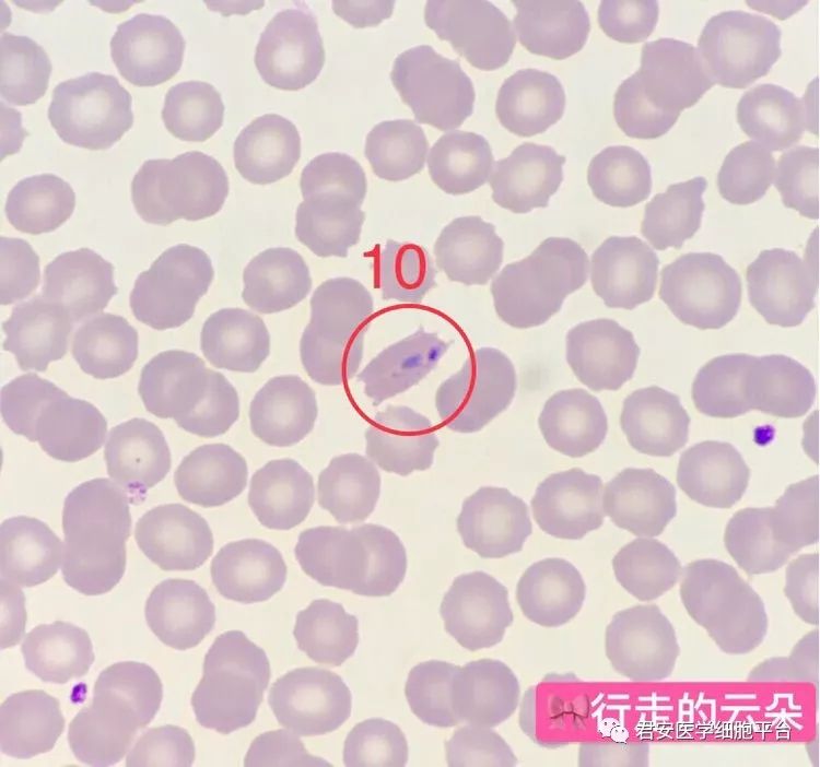 ▼「疟原虫环状体」形态特征:感染虫体的红细胞胀大,呈椭圆形伞矢状