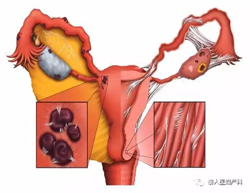 肺,乳腺,甚至於臀,大腿等處,但絕大多數位於盆腔臟器和壁腹膜,以卵巢