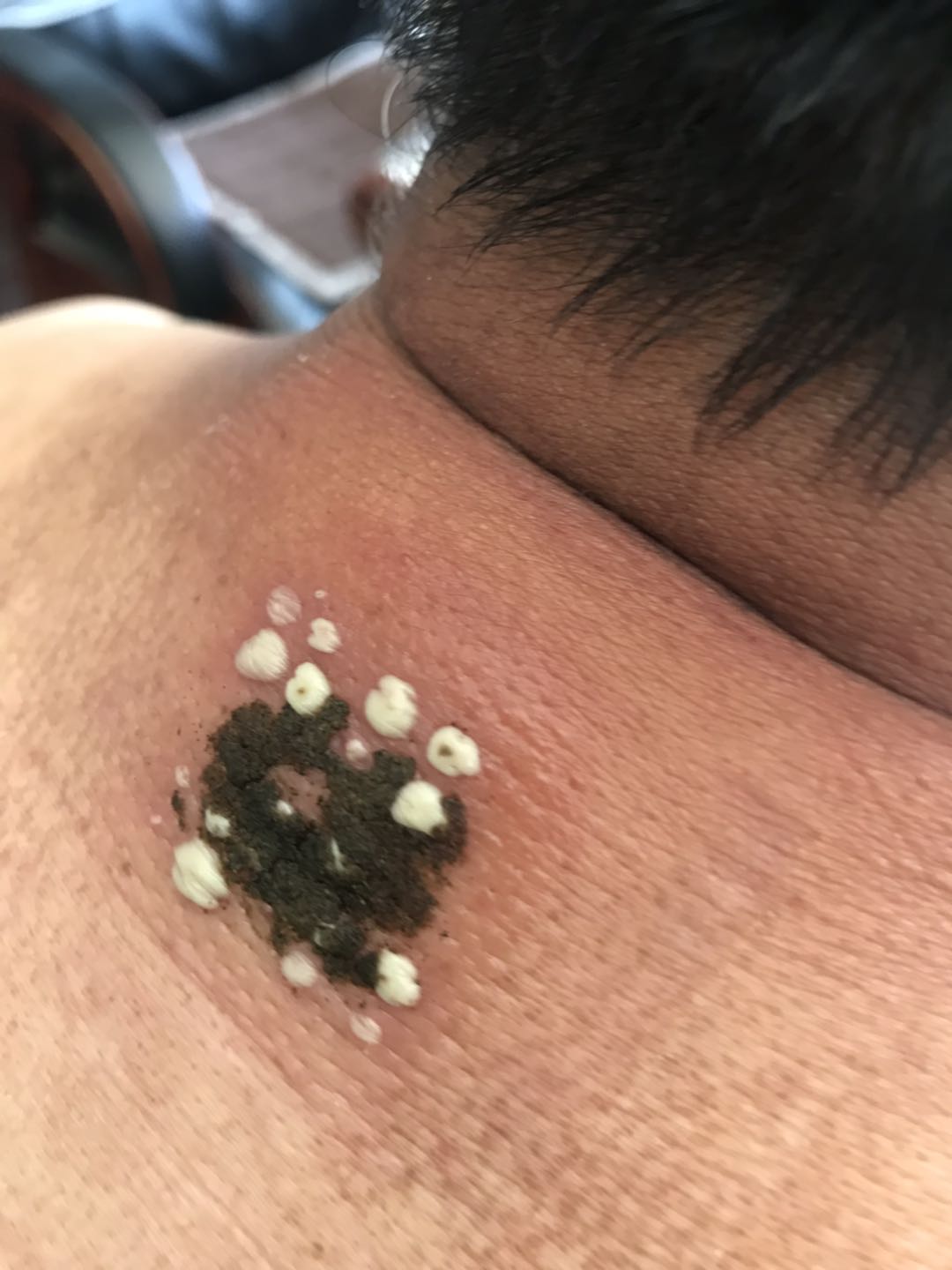 毒,邪,在特定的穴位里将,毒,邪,引到安全地方排出体外,(提脓拨毒,引流