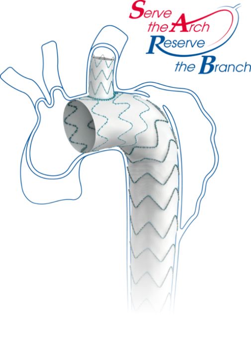 主动脉夹层支架植入术图片