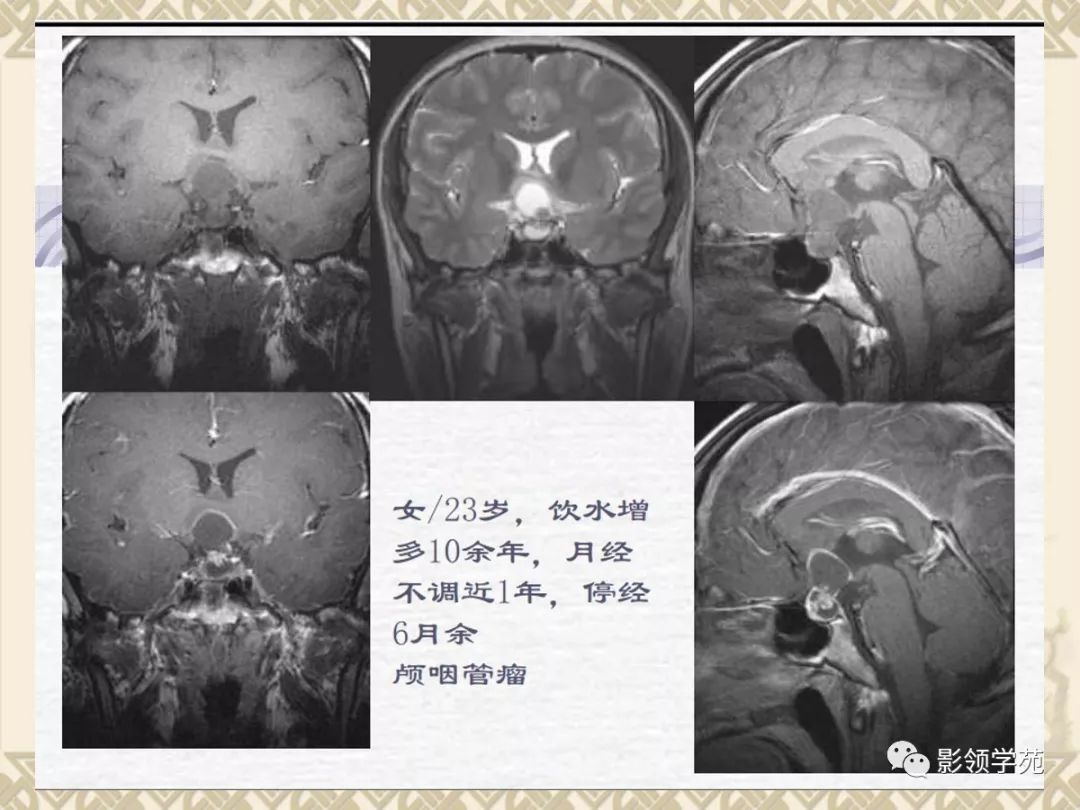 垂體病變的mri診斷