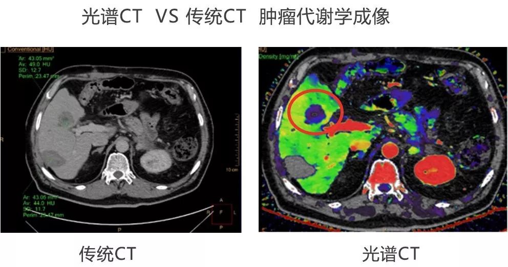 利用能谱曲线,碘定量测量等多参数分析技术,iqon光谱ct能够在一次扫描