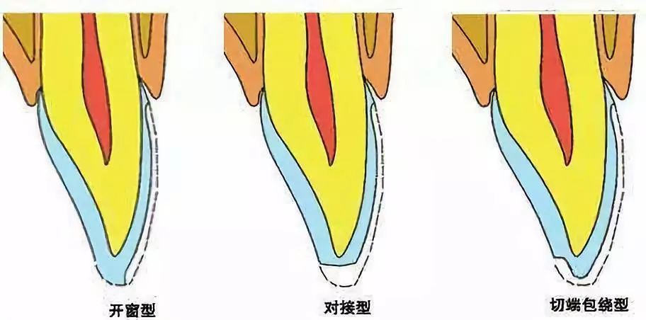 高嵌体预备制作示意图图片