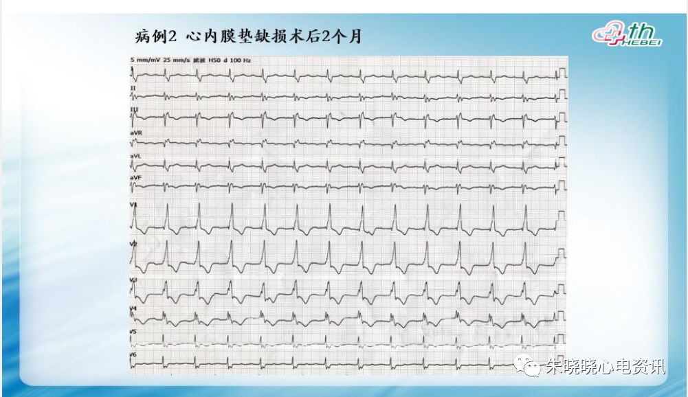 【yy语音】耿旭红老师:先天性心脏病心电图表现 2019