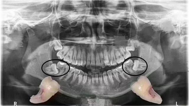 账单也是让人心痛啊,万一智齿把邻牙顶坏,那又是一笔开销↓智齿带来的