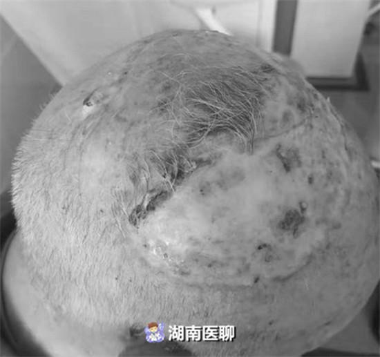 手术中,耳鼻咽喉头颈外科邓忠主任及刘中武主治医师为患者切除了头皮