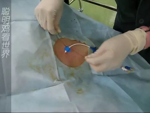 图解腋静脉穿刺置管术