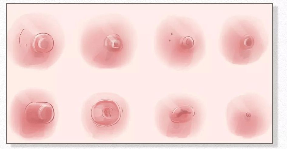 几种常见的乳头形态↓↓乳头凹进去是正常现象07步入中年,胸部会慢慢