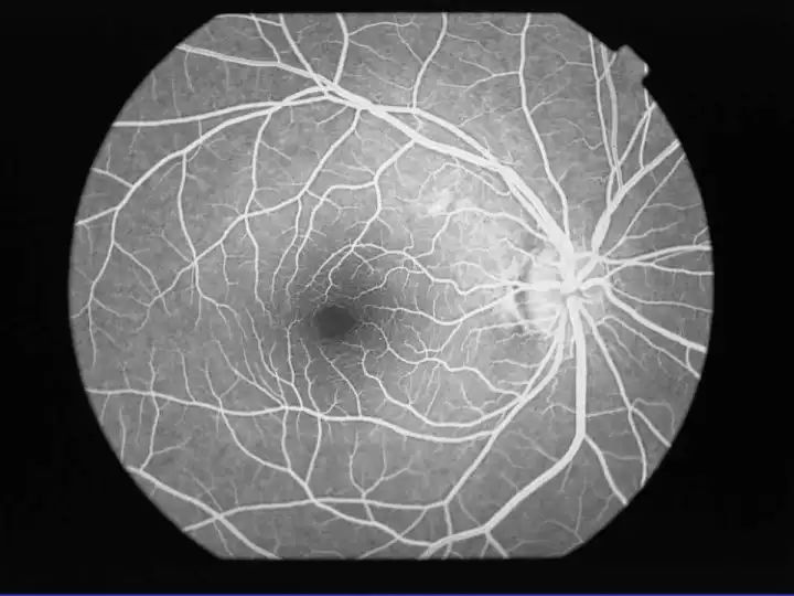 正常眼底荧光造影图片图片