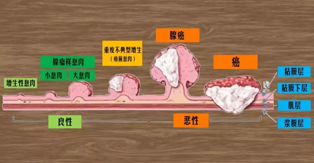 查出息肉结节离癌症还有多远肿瘤专家1个方法有效阻断癌变