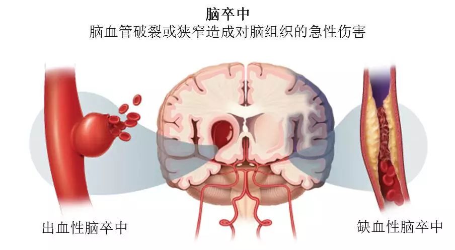 包括缺血性和出血性卒中