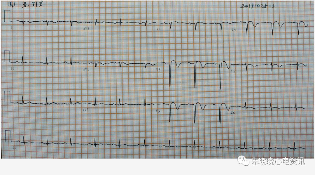 前降支病变心电图特征图片