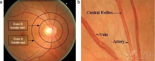 内屏障rpe与其间的闭合小带构成视网膜外屏障视网膜的内屏障及外屏障