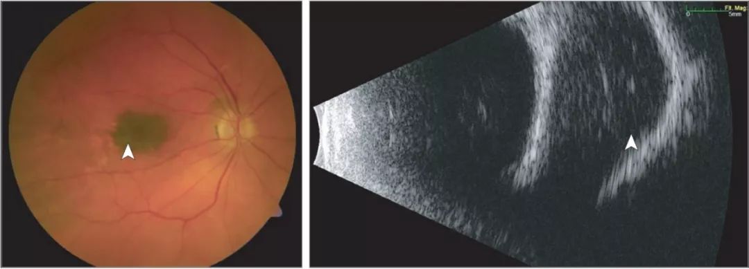 惟视诊室一颗奇怪的脉络膜痣