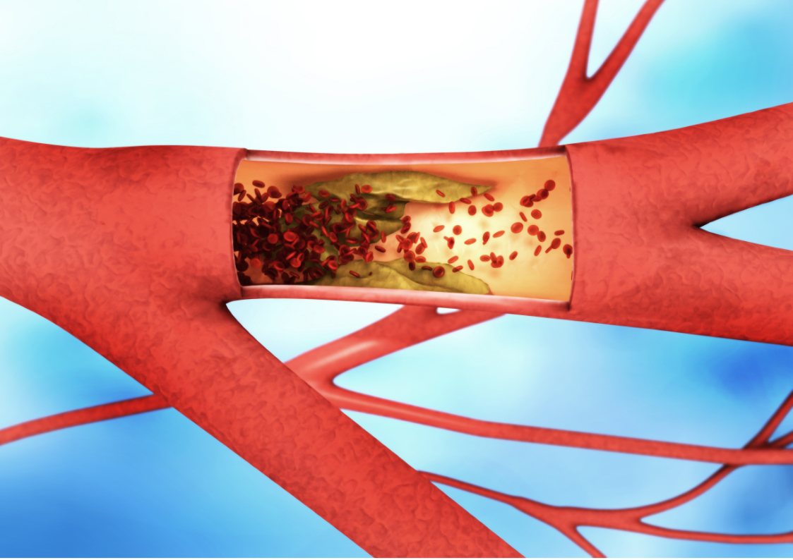 血管里根本沒有垃圾血管堵塞的3個真相你需要知道