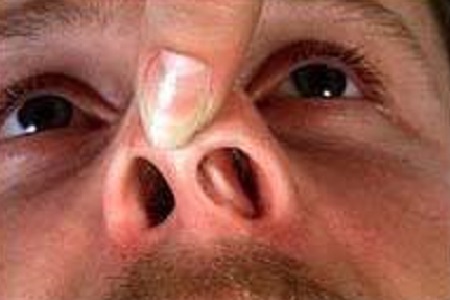 鼻甲肥大图片症状图片图片