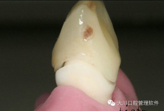 如何戴牙检验支点在哪里呢?