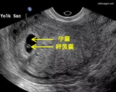 孕囊偏左侧宫角示意图图片