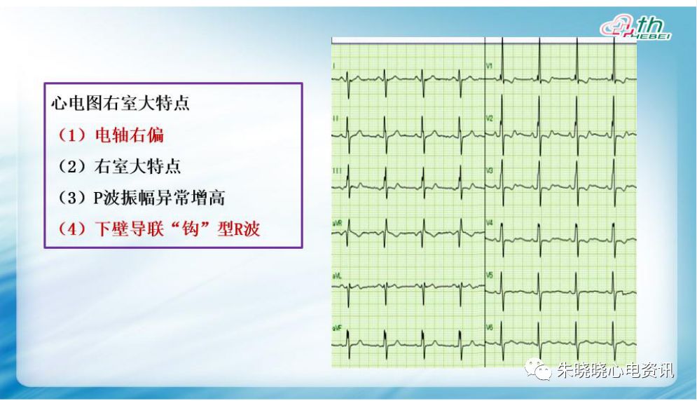 yy語音耿旭紅老師先天性心臟病心電圖表現20191022視頻圖片