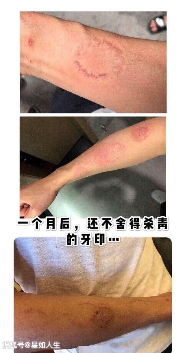 镶牙咬牙印步骤图图片