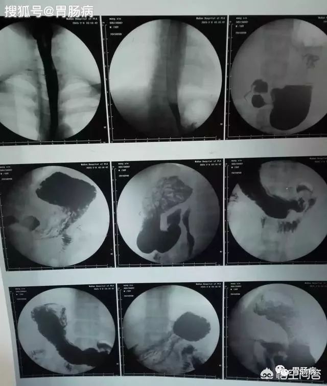鋇餐不能替代胃鏡拒做胃鏡29歲小夥胃癌當潰瘍耽誤了