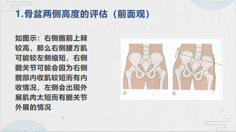 骨盆左高右低矫正图解图片