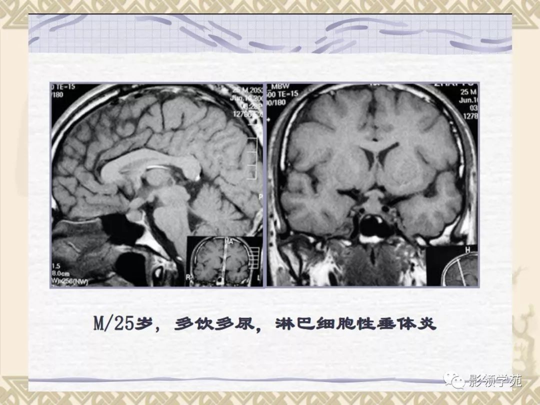 垂體病變的mri診斷