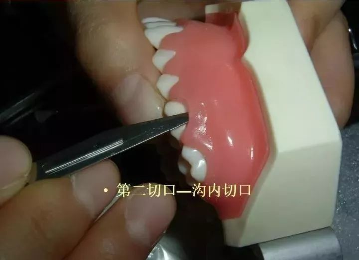 牙医必备技能之松牙固定术