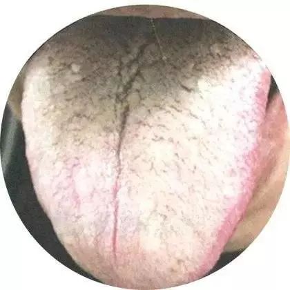 如何看你的舌头——舌苔篇白苔黄苔褐苔黑苔