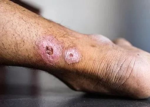 食肉菌在澳洲蔓延清洁能源金融公司(cefc)将获得10亿