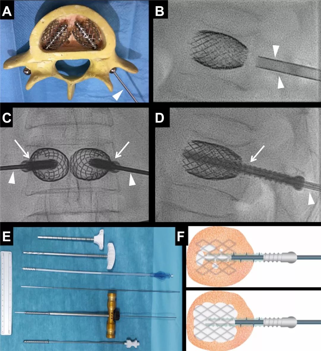 支架螺钉辅助内固定(saif)技术