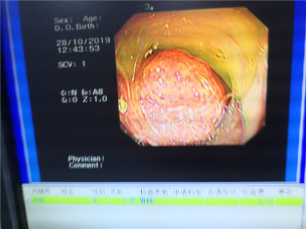 接诊医生说,按照常理,息肉不会引起疼痛,但小宝的息肉长在了结肠肝曲
