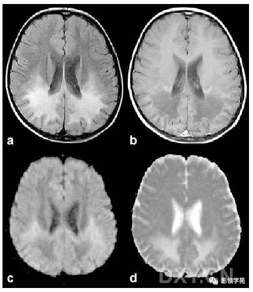 老人脑白质病变图片