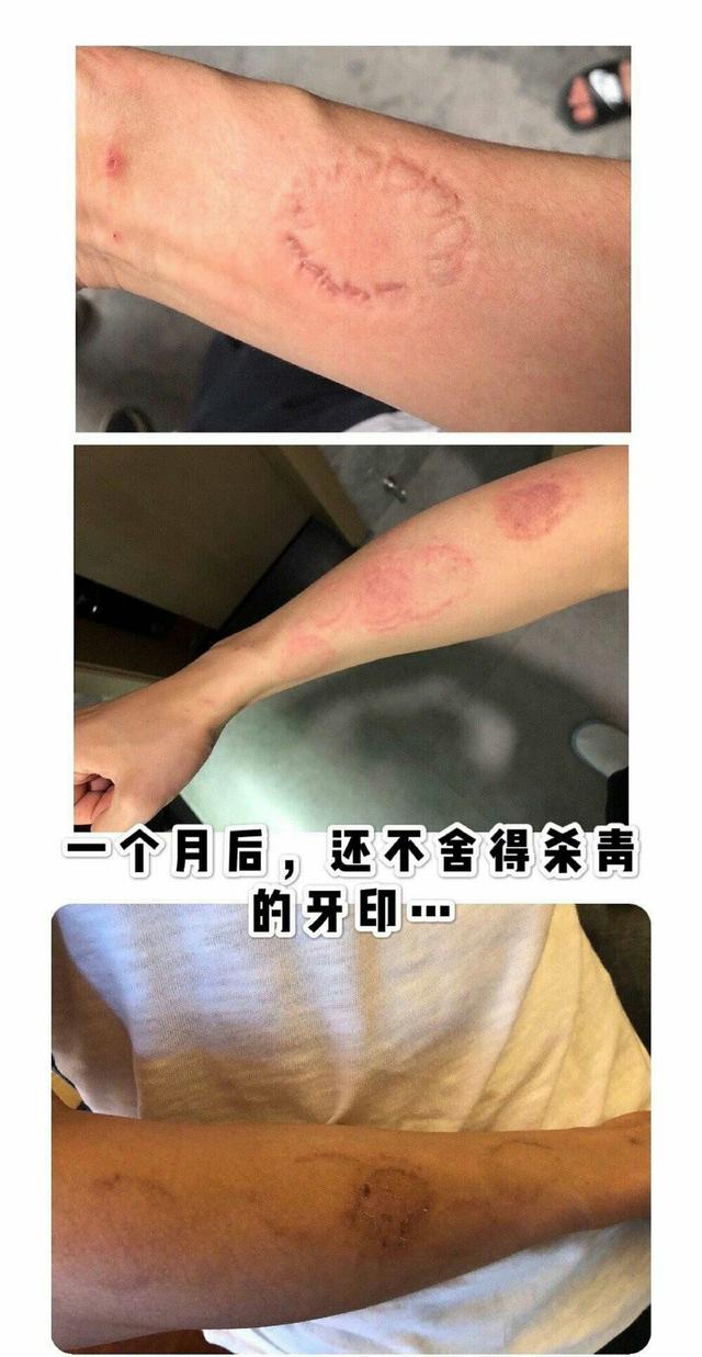 少年的你配角被周冬雨咬坏了手臂上全是咬痕一个月都没消