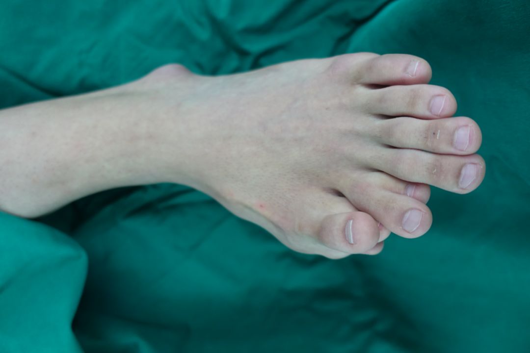 世界上脚趾最长的人图片