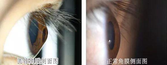十岁儿童散光高达700度本以为是近视了原来是因为