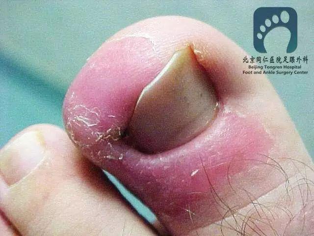 骨科大夫告诉您:脚趾甲长到肉里怎么办?