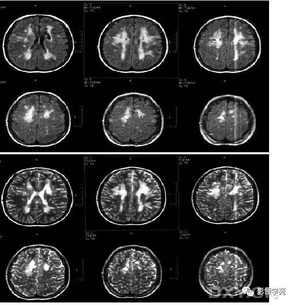 好货脑白质病变影像诊断