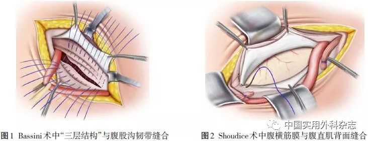 腹直肌缝合图片图片