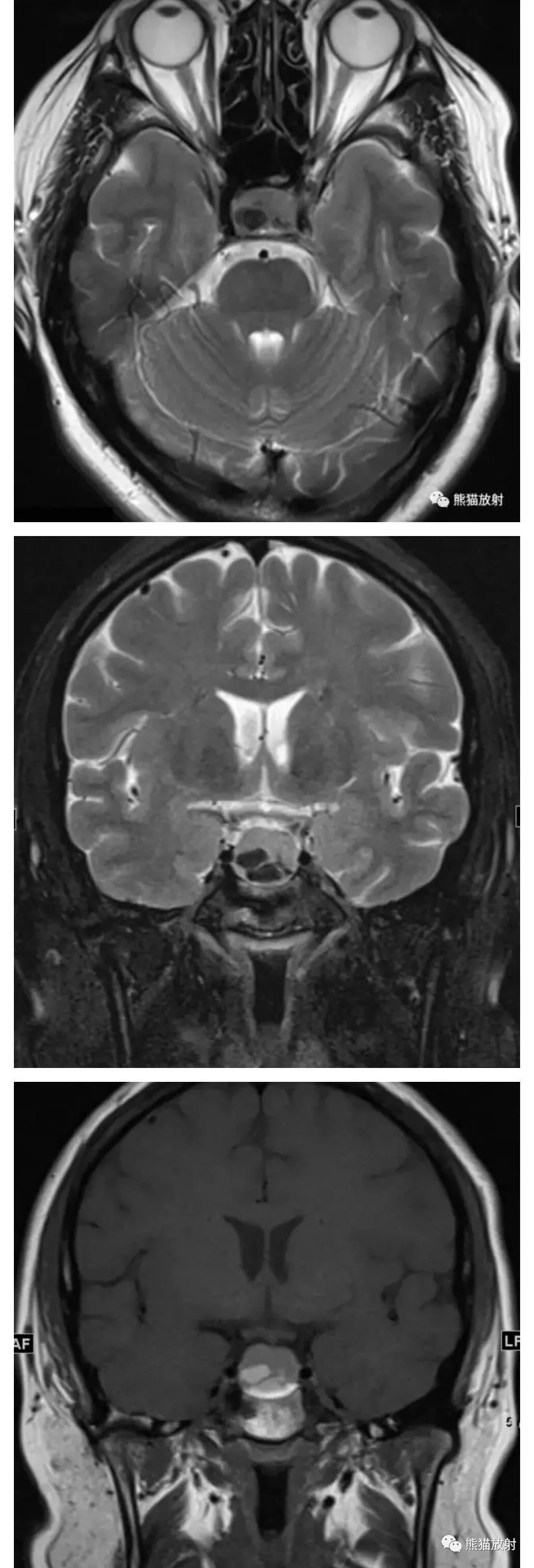 鞍区t1高信号病变之[rathke囊肿]丨小打卡读片精选(27)