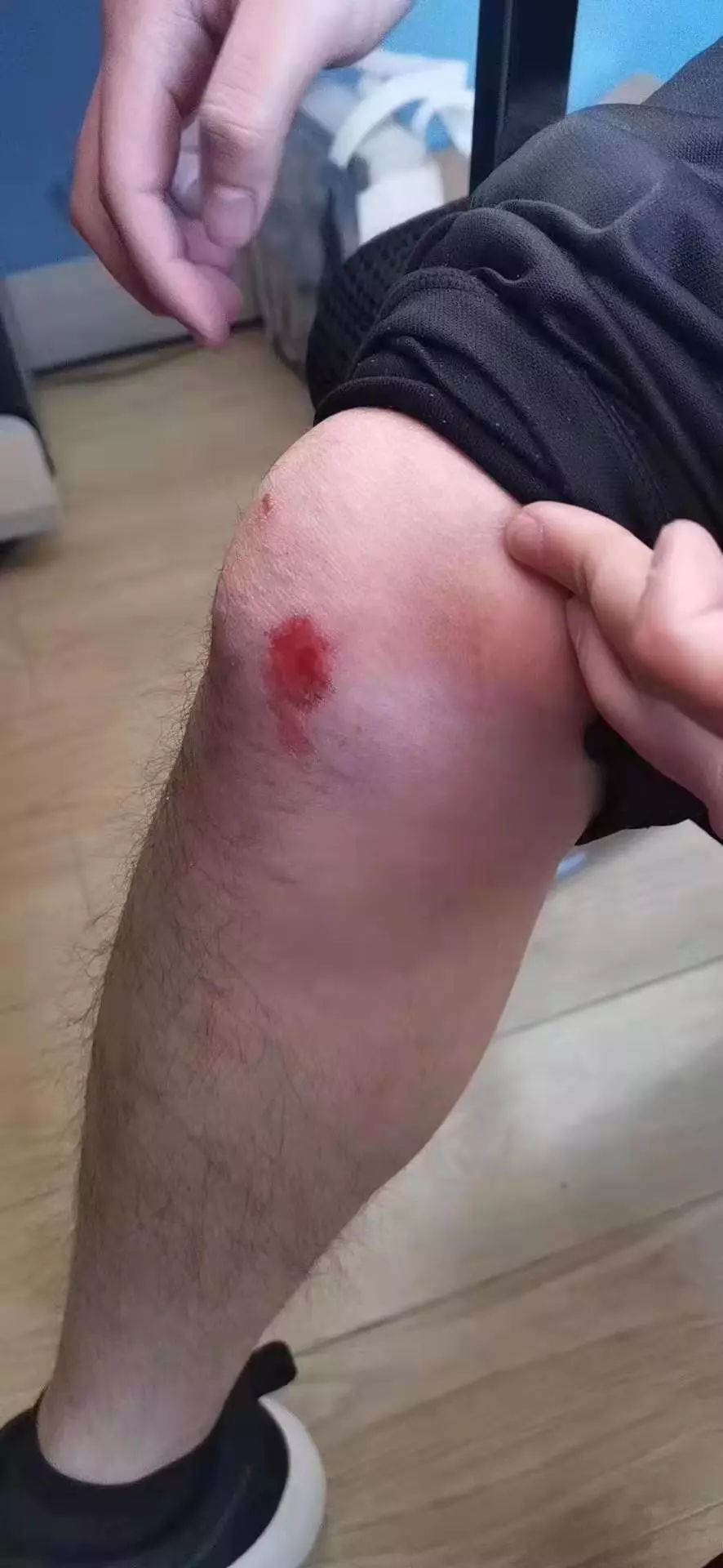 丽江城区发生一起非机动车连环交通事故,受害人直呼委屈