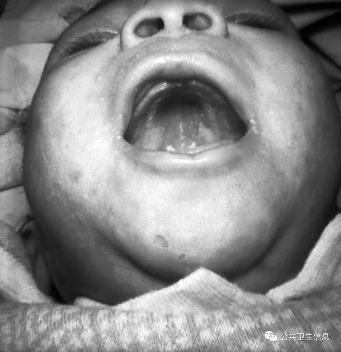 先天性梅毒婴儿图片