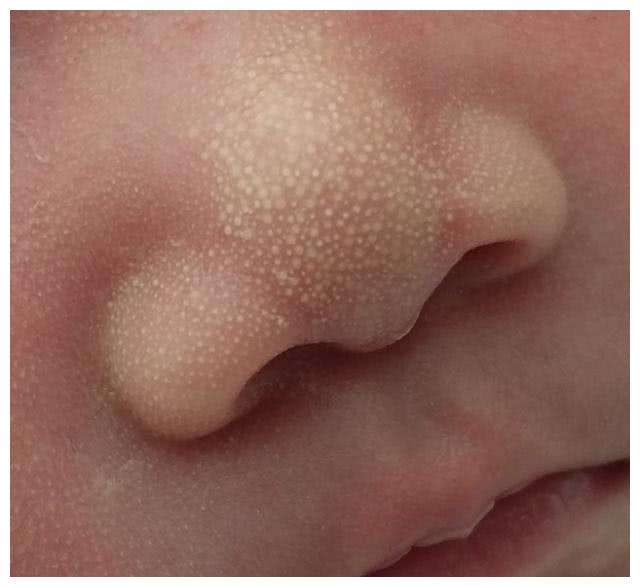 一般鼻子或者面部出现这种小颗粒,是属于脂肪细胞堆积