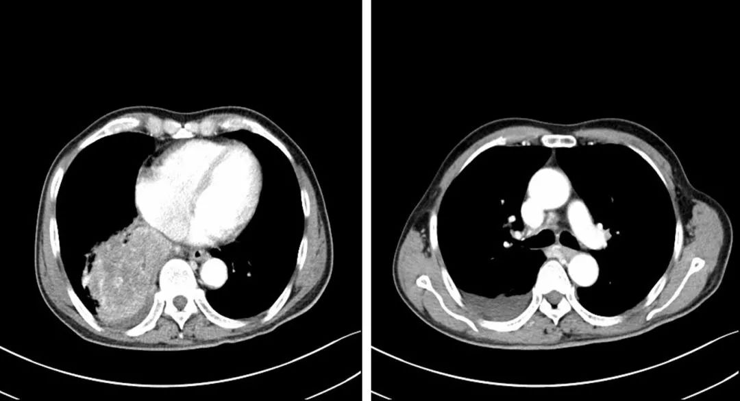 肺部肿瘤鳞状图片