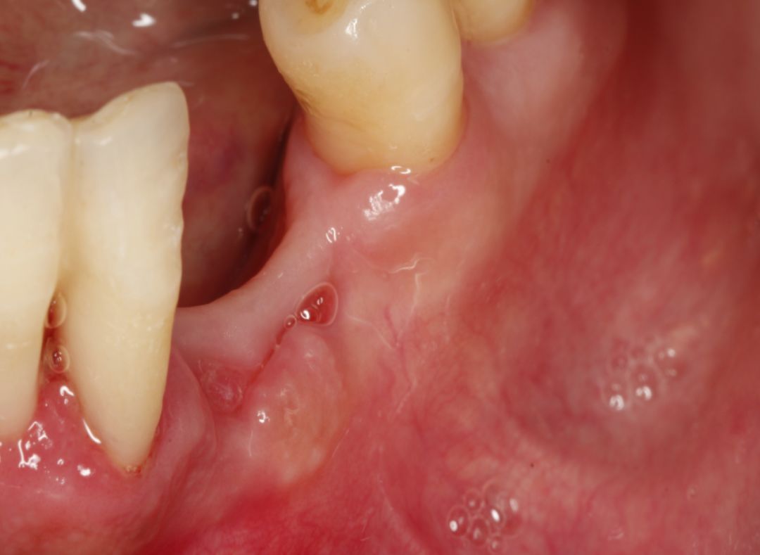 牙槽嵴低平图片