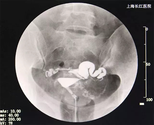 输卵管增粗是怎么回事?还能怀孕吗?