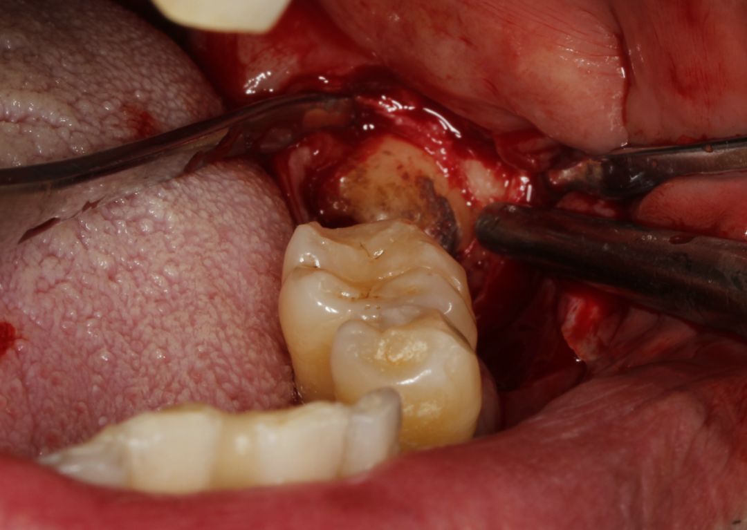 牙周炎患者埋伏牙拔除与牙槽嵴重建及种植修复一例海奥种植长廊