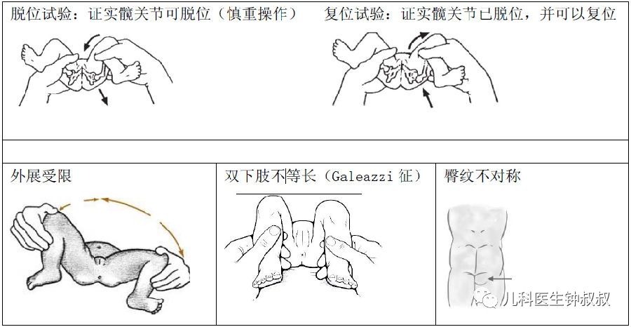 屈髋外展试验 ⑵allis(galeszzi)征 ⑶ortolani试验 ⑷barlow试验 ⑸