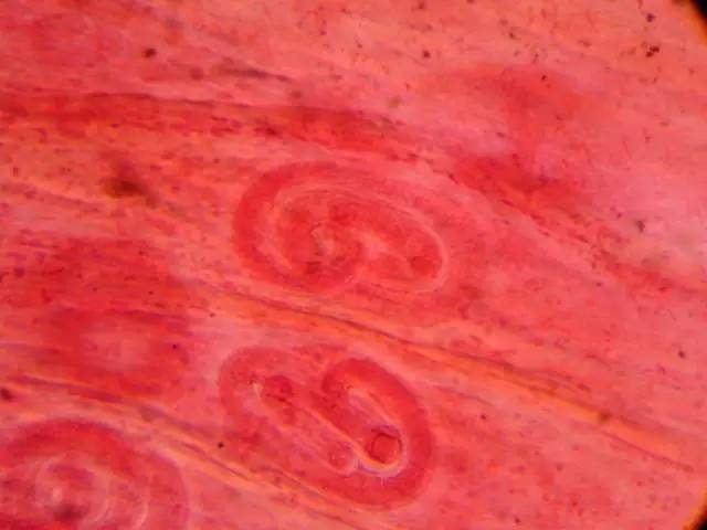 女子乳房里取出3条活虫医生都吓一跳原来她从小爱喝